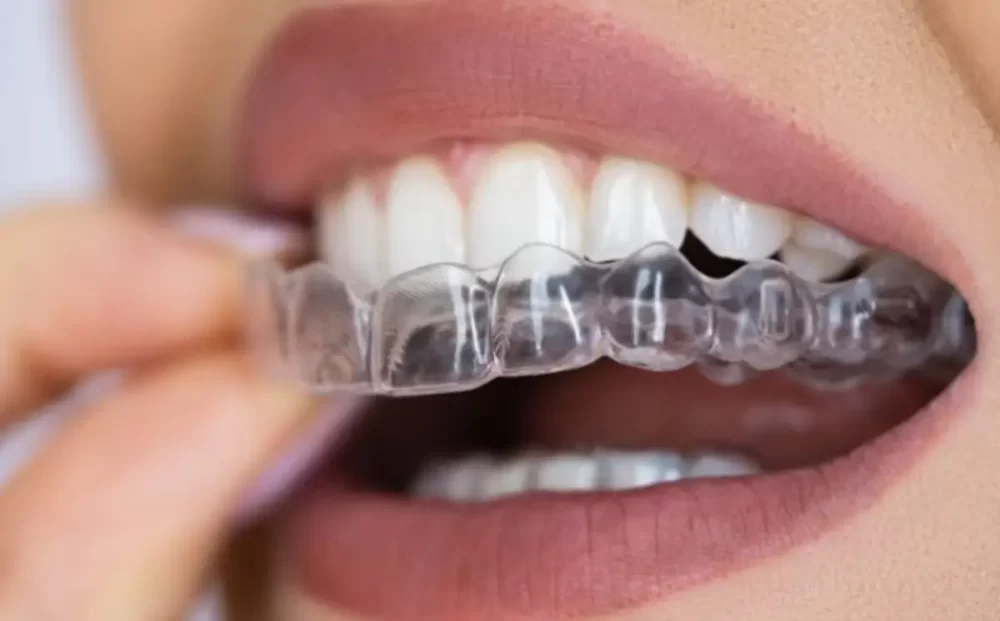invisalign-treatment