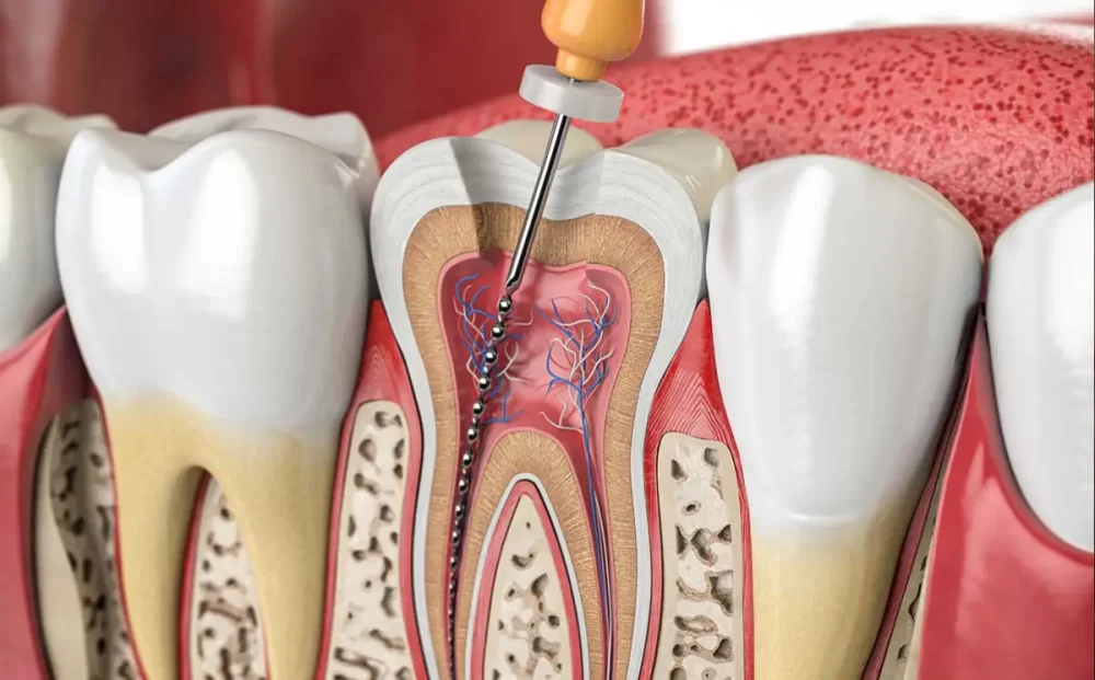 root-canal-treatment