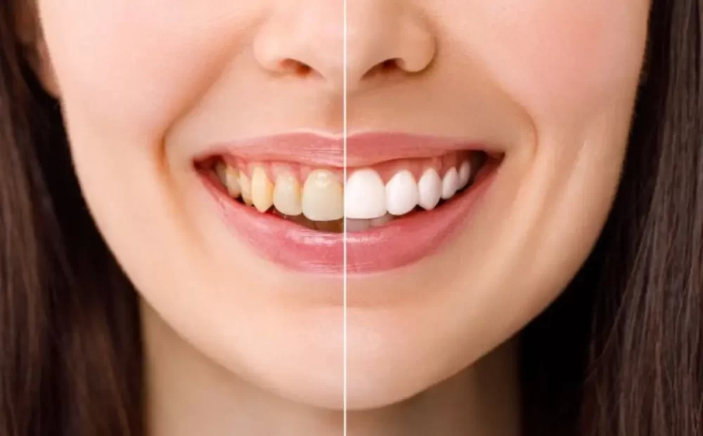 teeth-whitening