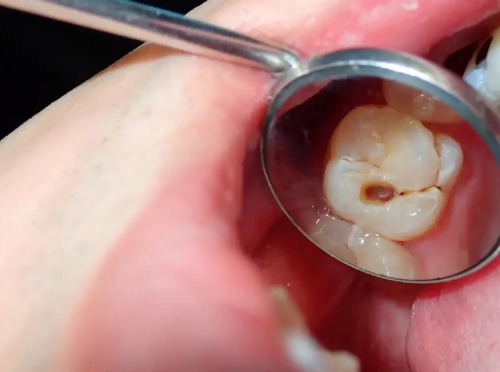 how-to-prevent-cavities-and-tooth-decay how-to-prevent-cavities-and-tooth-decay