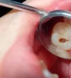 how-to-prevent-cavities-and-tooth-decay