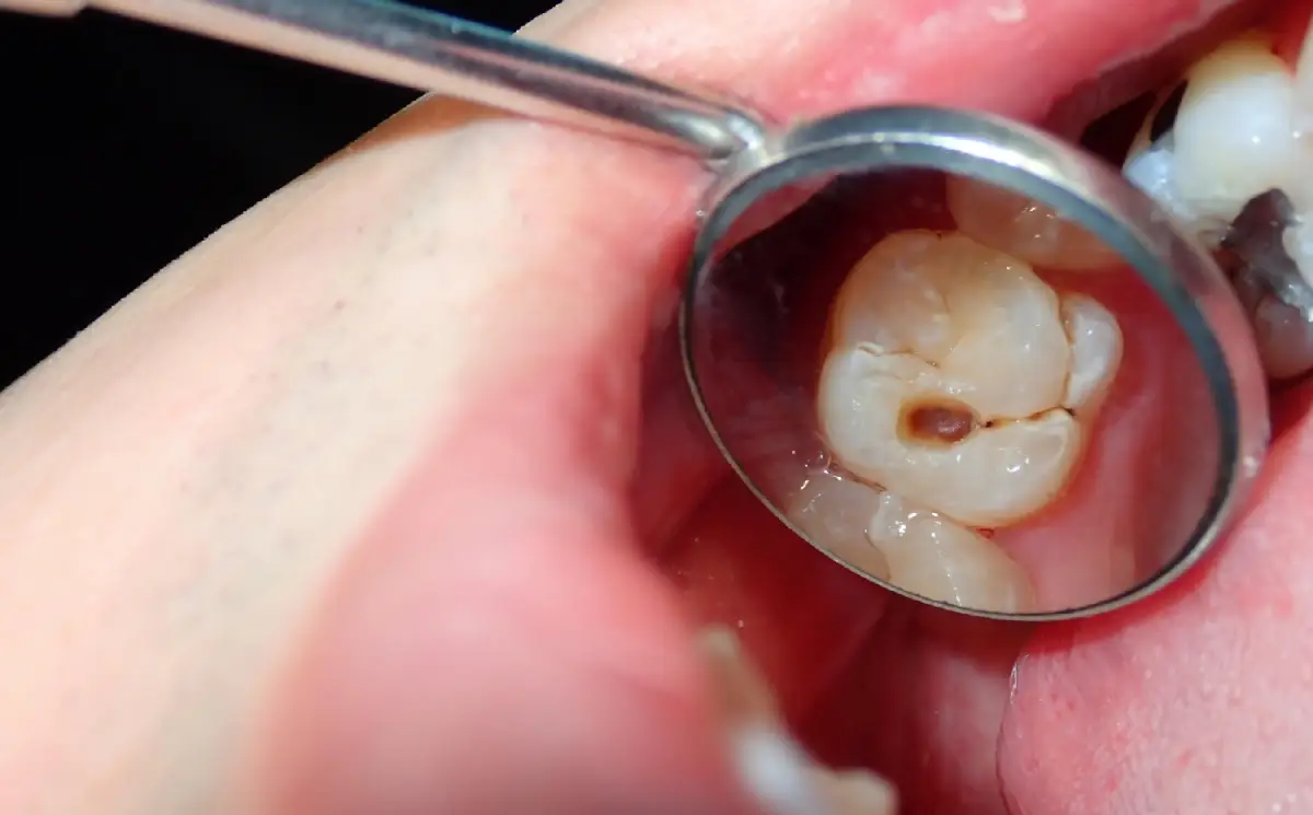 how-to-prevent-cavities-and-tooth-decay