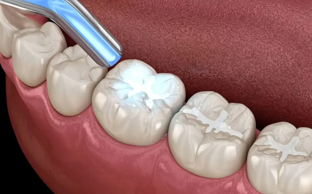 aesthetic-fillings