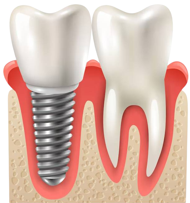 dental-implant-tooth