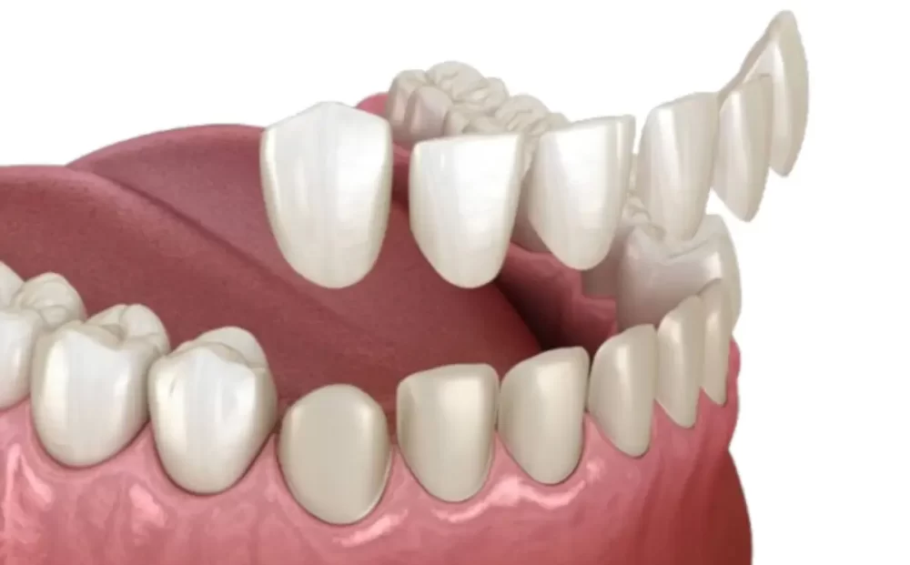 dental-veneers