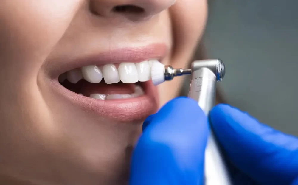 scaling-and-polishing