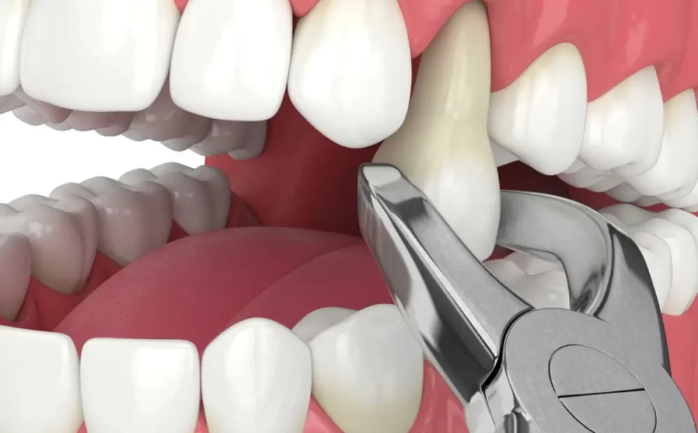 tooth-extraction